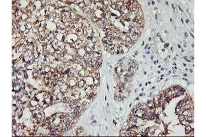 Immunohistochemical staining of paraffin-embedded Adenocarcinoma of Human ovary tissue using anti-PDSS2 mouse monoclonal antibody. (PDSS2 antibody)