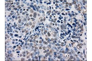 Immunohistochemical staining of paraffin-embedded Adenocarcinoma of ovary tissue using anti-GBE1 mouse monoclonal antibody.