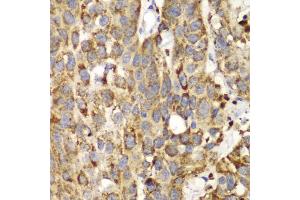 Immunohistochemistry of paraffin-embedded human lung cancer using SHMT2 Antibody (ABIN5970557) at dilution of 1/100 (40x lens). (SHMT2 antibody)