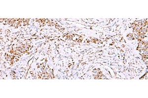 Immunohistochemistry of paraffin-embedded Human ovarian cancer tissue using HSF2BP Polyclonal Antibody at dilution of 1:30(x200)