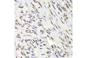 Immunohistochemistry of paraffin-embedded human adenomyosis using HNRNPD Antibody. (HNRNPD/AUF1 antibody  (AA 1-306))