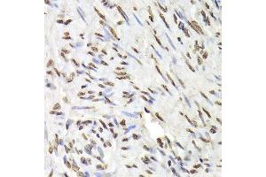 Immunohistochemistry of paraffin-embedded human adenomyosis using HNRNPD Antibody. (HNRNPD/AUF1 antibody  (AA 1-306))