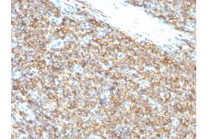 Formalin-fixed, paraffin-embedded human Ewing's Sarcoma stained with CD99 Monoclonal Antibody (12E7).