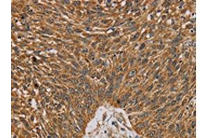 The image on the left is immunohistochemistry of paraffin-embedded Human lung cancer tissue using ABIN7130359(NDEL1 Antibody) at dilution 1/20, on the right is treated with fusion protein. (NDEL1 antibody)