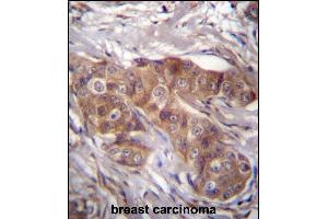 LR6 Antibdy (Center) (ABIN656635 and ABIN2845880) immunohistochemistry analysis in formalin fixed and raffin embedded human breast carcinoma followed by peroxidase conjugation of the secondary antibody and DAB staining. (LPAR6 antibody  (AA 106-134))