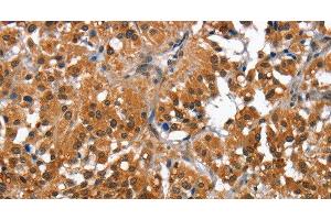Immunohistochemistry of paraffin-embedded Human thyroid cancer tissue using CAMK1D Polyclonal Antibody at dilution 1:50 (CAMK1D antibody)