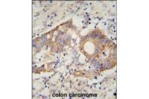 HHLA2 Antibody immunohistochemistry analysis in formalin fixed and paraffin embedded human colon carcinoma followed by peroxidase conjugation of the secondary antibody and DAB staining.