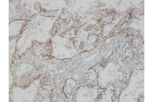 IHC-P Image Immunohistochemical analysis of paraffin-embedded human T(IV)(lung CA), using CLIC3, antibody at 1:100 dilution. (CLIC3 antibody)