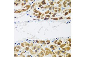 Immunohistochemistry of paraffin-embedded human liver cancer using NAA60 antibody. (NAT15 antibody)