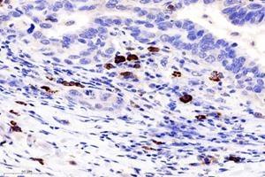Immunohistochemistry analysis of paraffin-embedded human lung cancer using TCRb (ABIN7075813) at dilution of 1: 1800 (TCRb antibody)