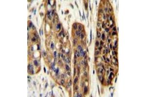 Immunohistochemistry analysis in formalin fixed and paraffin embedded human esophagus carcinoma reacted with KIAA1324L Antibody (N-term) followed which was peroxidase conjugated to the secondary antibody and ollowed by DAB staining. (KIAA1324-Like antibody  (N-Term))