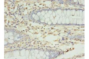 Immunohistochemistry of paraffin-embedded human colon cancer using ABIN7166018 at dilution of 1:100 (RMND5B antibody  (AA 1-260))