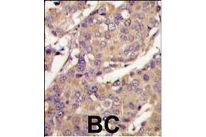 Formalin-fixed and paraffin-embedded breast carcinoma tissue reacted with UBE2L6 Antibody (C-term) (ABIN388854 and ABIN2839156) , which was peroxidase-conjugated to the secondary antibody, followed by DAB staining. (UBE2L6 antibody  (C-Term))
