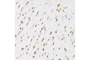 Immunohistochemistry of paraffin-embedded human gastric cancer using RUVBL1 Antibody. (RUVBL1 antibody  (AA 1-240))