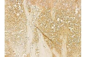 ABIN6258456 and ABIN6275894 at 1/100 staining human breast carcinoma by IHC-P.