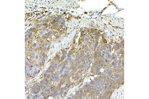 Immunohistochemistry of paraffin-embedded human esophageal cancer using IFIH1 Rabbit pAb (ABIN6131879, ABIN6142174, ABIN6142175 and ABIN6217724) at dilution of 1:50 (40x lens). (IFIH1 antibody  (AA 1-205))