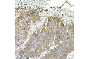Immunohistochemistry of paraffin-embedded human esophageal cancer using IFIH1 Rabbit pAb (ABIN6131879, ABIN6142174, ABIN6142175 and ABIN6217724) at dilution of 1:50 (40x lens).