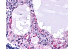Anti-TSH Receptor / TSHR antibody IHC of human Thyroid, Follicular Carcinoma. (TSH receptor antibody  (N-Term))