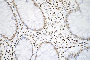 Immunohistochemistry was performed on paraffin-embedded human sigmoid colon carcinoma using histone H3 (acetyl K27) antibody (ABIN7798971), 1:200).