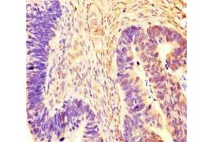 Immunohistochemistry of paraffin-embedded human ovarian cancer using ABIN7167721 at dilution of 1:100 (CoREST antibody  (AA 394-482))