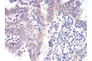 Immunohistochemical analysis of paraffin-embedded endometrial cancer tissues using ALDH6A1 mouse mAb with DAB staining.