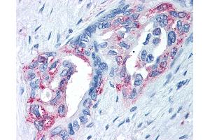 Anti-TRPM8 antibody IHC of human Pancreas, Carcinoma. (TRPM8 antibody  (Internal Region))