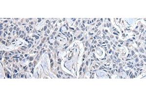 Immunohistochemistry of paraffin-embedded Human lung cancer tissue using PPIG Polyclonal Antibody at dilution of 1:50(x200) (PPIG antibody)