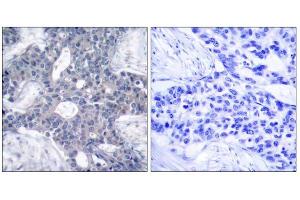 Immunohistochemical analysis of paraffin-embedded human breast carcinoma tissue, using Zap-70 (Ab-493) antibody (E021174). (ZAP70 antibody)