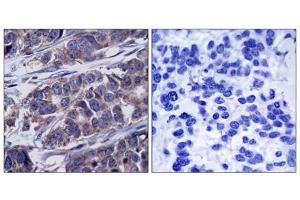Immunohistochemical analysis of paraffin-embedded human breast carcinoma tissue, using p62Dok (phospho-Tyr362) antibody (E011276). (DOK1 antibody  (pTyr362))