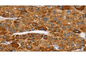 Immunohistochemistry of paraffin-embedded Human liver cancer tissue using SPARCL1 Polyclonal Antibody at dilution 1:30 (SPARCL1 antibody)