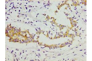 IHC image of ABIN7148223 diluted at 1:300 and staining in paraffin-embedded human breast cancer performed on a Leica BondTM system. (COL11A1 antibody  (AA 532-699))