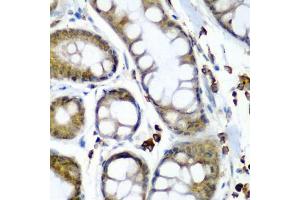 Immunohistochemistry of paraffin-embedded human colon carcinoma using SECISBP2 antibody (ABIN6128699, ABIN6147497, ABIN6147498 and ABIN6222461) at dilution of 1:200 (40x lens). (SECISBP2 antibody  (AA 585-854))