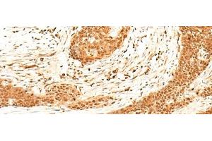 Immunohistochemistry of paraffin-embedded Human esophagus cancer tissue using HNF4A Polyclonal Antibody at dilution of 1:40(x200) (HNF4A antibody)