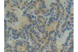 IHC-P analysis of Human Thyroid cancer Tissue, with DAB staining.