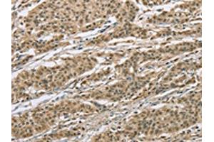 The image on the left is immunohistochemistry of paraffin-embedded Human gastic cancer tissue using ABIN7129356(ELAC2 Antibody) at dilution 1/30, on the right is treated with fusion protein. (ELAC2 antibody)