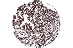 Strong membranous CD7 expression of an adenocarcinoma of the lung (Recombinant CD7 antibody)