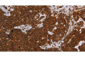 Immunohistochemistry of paraffin-embedded Human cervical cancer tissue using ERRFI1 Polyclonal Antibody at dilution 1:30 (ERRFI1 antibody)