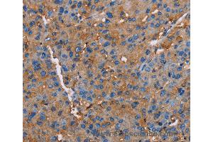 Immunohistochemistry of Human liver cancer using NLGN1 Polyclonal Antibody at dilution of 1:50