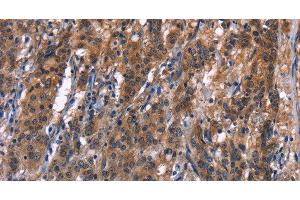 Immunohistochemistry of paraffin-embedded Human gastric cancer tissue using R3HCC1L Polyclonal Antibody at dilution 1:40 (GIDRP88 antibody)