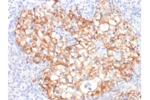 Formalin-fixed, paraffin-embedded human Renal Cell Carcinoma stained with CDH16-Monospecific Mouse Monoclonal Antibody (CDH16/2125). (Cadherin-16 antibody  (AA 371-507))