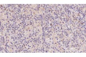 ABIN6273112 at 1/100 staining Human lymph cancer tissue by IHC-P. (DnaJ (Hsp40) Homolog, Subfamily B, Member 3 (DNAJB3) (Internal Region) antibody)