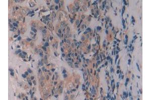 IHC-P analysis of Human Breast cancer Tissue, with DAB staining. (Caveolin-1 antibody  (AA 2-104))