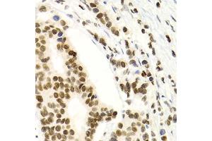 Immunohistochemistry of paraffin-embedded human breast cancer using NFKB2 Antibody (ABIN1873900) at dilution of 1:100 (40x lens). (NFKB2 antibody)