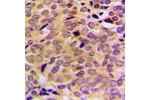 Immunohistochemical analysis of MRPL21 staining in human breast cancer formalin fixed paraffin embedded tissue section.