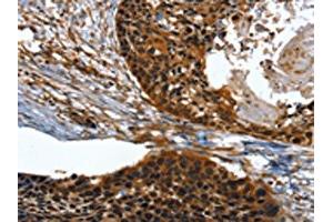 The image on the left is immunohistochemistry of paraffin-embedded Human esophagus cancer tissue using ABIN7131518(TWF1 Antibody) at dilution 1/30, on the right is treated with fusion protein. (TWF1 antibody)