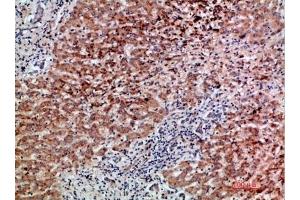 Immunohistochemical analysis of paraffin-embedded human-liver-cancer, antibody was diluted at 1:200.