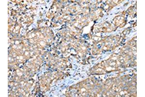The image on the left is immunohistochemistry of paraffin-embedded Human breast cancer tissue using ABIN7128073(VAPA Antibody) at dilution 1/30, on the right is treated with fusion protein.