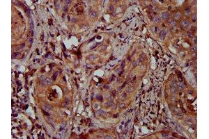 IHC image of ABIN7159706 diluted at 1:300 and staining in paraffin-embedded human cervical cancer performed on a Leica BondTM system. (MFAP4 antibody  (AA 100-191))