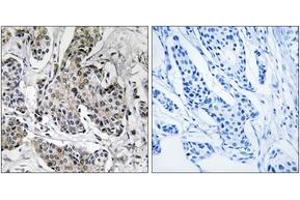 Immunohistochemistry analysis of paraffin-embedded human breast carcinoma tissue, using PRKX Antibody. (PRKX antibody  (AA 251-300))