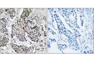 Immunohistochemistry analysis of paraffin-embedded human breast carcinoma tissue, using PRKX Antibody.